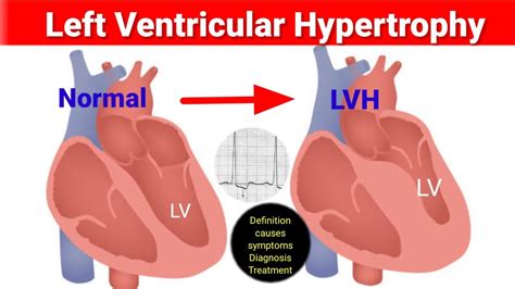 is mild lvh serious.